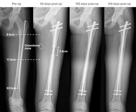 soft tissue concerns) why other methods would be chosen. . Cpt code intramedullary nail femur